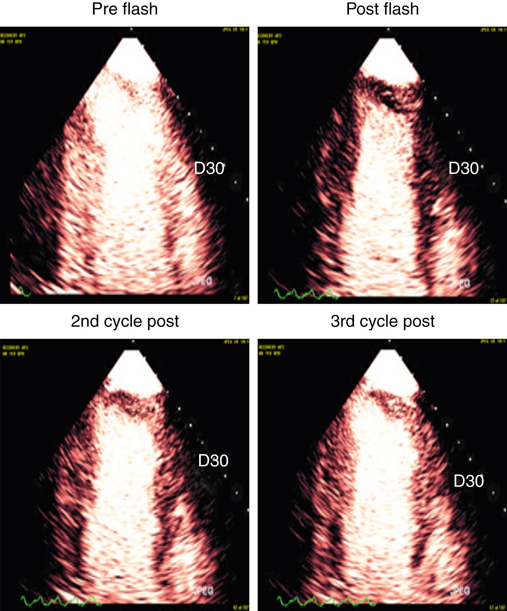 Figure 55.3, Replenishment of myocardial contrast enhancement after a high–mechanical index (termed the “flash”) impulse. The rate of replenishment correlates with red blood cell velocity, and the plateau intensity (at end-systole) correlates with the capillary cross-sectional area. The product of these two correlates with capillary blood flow. Because capillary blood flow is typically 1 mm/s under resting conditions and at least 2 mm/s during any form of hyperemic stress, the typical replenishment after a high-MI impulse and a two- dimensional transducer (4-mm elevation plane) should be within 4 seconds under resting conditions and within 2 seconds during stress imaging as shown in this example.