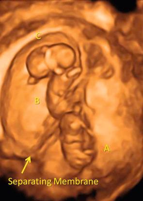 FIG 7-13, Dichorionic triplet gestation with a monochorionic pair (B and C) in which amnionicity could not be firmly established early in the pregnancy. A membrane ( arrow ) was seen separating triplet A from B and C.