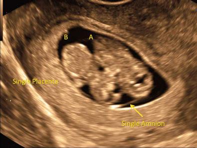 FIG 7-14, Lack of an intervening membrane and visualization of a single amnion ( arrow ) confirms monochorionic monoamnionic twin pregnancy.