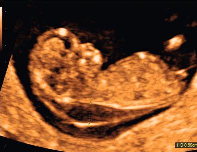 FIG 7-15, Monochorionic diamniotic twin pregnancy in which twin A was noted to have an enlarged nuchal translucency (NT) measuring 0.59 cm.