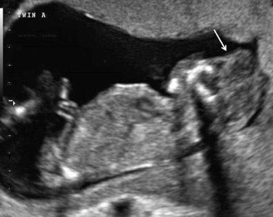 FIG 7-18, Absence of the calvarium ( arrow ) suggesting acrania in twin A of a monochorionic diamniotic pregnancy.