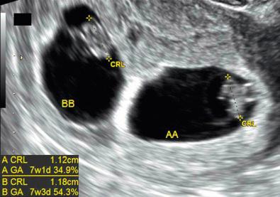 FIG 7-6, First trimester crown-rump length (CRL) optimal for pregnancy dating. GA, gestational age.
