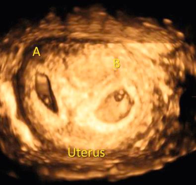 FIG 7-7, Three - dimensional image of two distinct gestational sacs (A and B) indicating a dichorionic twin pregnancy.