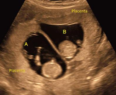 FIG 7-8, Visualization of two separate placentas confirms dichorionicity.