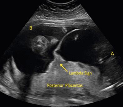 FIG 7-9, The lambda sign ( arrow ) represents chorionic tissue wedged between layers of the intervening membrane (separating the gestational sacs of twins A and B) where it meets the fetal surface of the abutting placentas. This finding is not always present, but when seen, it is a useful indicator of dichorionicity.