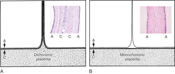 FIG 7-10, Twin peak sign with placental pathologic images of fetal membranes. A, Diagram of the twin peak sign in dichorionic twin gestations. The chorion (C) and amnion (A) of each twin reflect away from the fused placenta to form the inter-twin membrane. A potential space exists between the membranes, which are filled with the amniotic and chorionic mesoderm as seen in the pathologic images of dichorionic membranes (see inset ). B, In monochorionic-diamniotic twins the inter-twin membrane is composed of only two amnions. A single chorion does not allow the chorionic mesoderm to access the potential space between the diamniotic membranes as seen in the pathologic sample of monochorionic fetal membranes (see inset ).