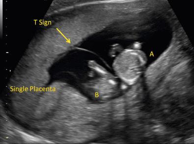 FIG 7-11, The T-sign ( arrow ) formed by the thin inter-twin membrane (composed of two layers of amnion, separating the sacs of A and B) where it meets perpendicular to the fetal surface of the single shared placenta—indicating a monochorionic diamniotic twin pregnancy.