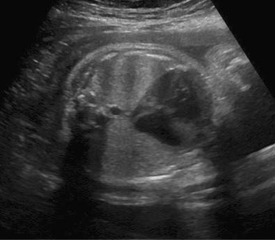 FIG 3-1, Apical four-chamber view in a second trimester fetus demonstrating hypoplastic left-sided heart syndrome.