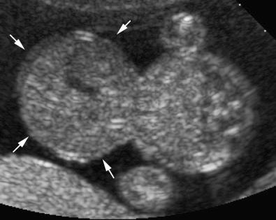 FIG 3-11, Large liver containing omphalocele ( arrows ) in a second trimester patient. The omphalocele is larger than the native fetal abdomen.