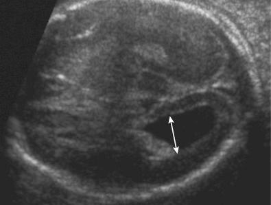 FIG 3-12, Transverse axial scan at midgestation demonstrates mild ventriculomegaly associated with trisomy 21 ( arrow ).