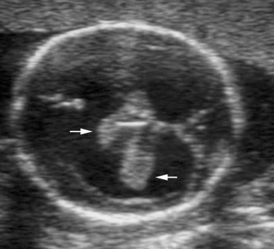 FIG 3-13, Marked dilation of both lateral ventricles with dangling choroid plexuses ( arrows ) in a fetus with hydrocephalus.