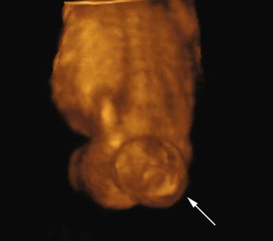 FIG 3-14, Three-dimensional sonogram showing the fetal back affected by a neural tube defect ( arrow ) in the lumbosacral area.