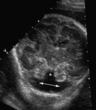 FIG 3-15, Dandy-Walker malformation in a trisomy 13 fetus. In a transverse axial plane, an enlarged fourth ventricle ( arrow ) is seen along with a defect in the cerebellar vermis. Note that the cerebellar hemispheres are splayed ( asterisk ).