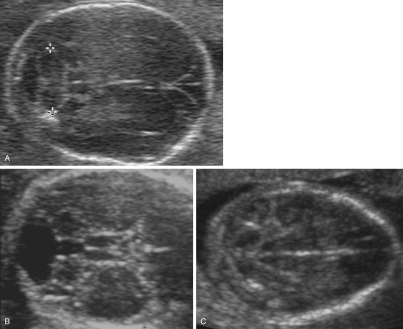 FIG 3-17, A, Normal posterior fossa. B, Vermian agenesis. C, Chiari II malformation.