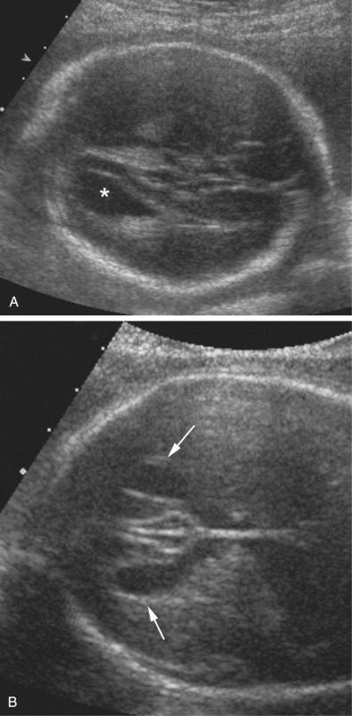 FIG 3-18, Fetus with agenesis of corpus callosum. A, Transverse axial scan through the lateral ventricle shows the characteristic teardrop shape of lateral ventricles or disproportionate enlargement of the occipital horns (colpocephaly) ( asterisk ), which is indicative of agenesis of corpus callosum. B, Widely separated frontal horns ( arrows ) are seen with absence of the cavum septum pellucidum.