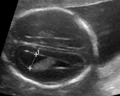 FIG 3-19, Agenesis of the corpus callosum. Transverse scan of the fetal head demonstrates mild ventriculomegaly, a characteristic teardrop shape of the lateral ventricle, and absence of the cavum septum pellucidum.
