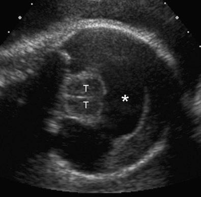 FIG 3-20, Transaxial view through the head of a trisomy 13 fetus, showing alobar holoprosencephaly. Note the fused thalami (T) surrounded by a single monoventricle ( asterisk ).