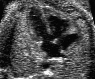 FIG 3-2, Apical four-chamber view of the fetal heart showing an inlet ventricular septal defect.