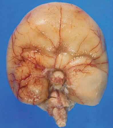 FIG 3-21, Surgical pathologic specimen of alobar holoprosencephaly in neonate affected with trisomy 13.