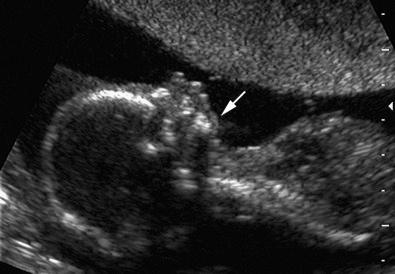 FIG 3-23, Abnormal facial profile, showing severe micrognathia ( arrow ).