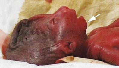 FIG 3-24, Gross pathologic features seen in the face of a neonate with trisomy 9. Note the sloping forehead, flat profile, small nose, and micrognathia ( arrow ).