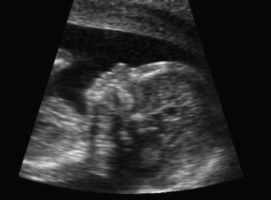 FIG 3-25, Facial profile of fetus with trisomy 18. The profile is flattened and there is a hypoplastic nasal bone.