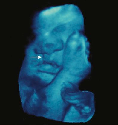 FIG 3-26, Three-dimensional image of the fetal face showing unilateral cleft lip ( arrow ).