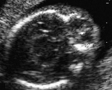 FIG 3-28, Marked hypotelorism in a fetus with trisomy 13.