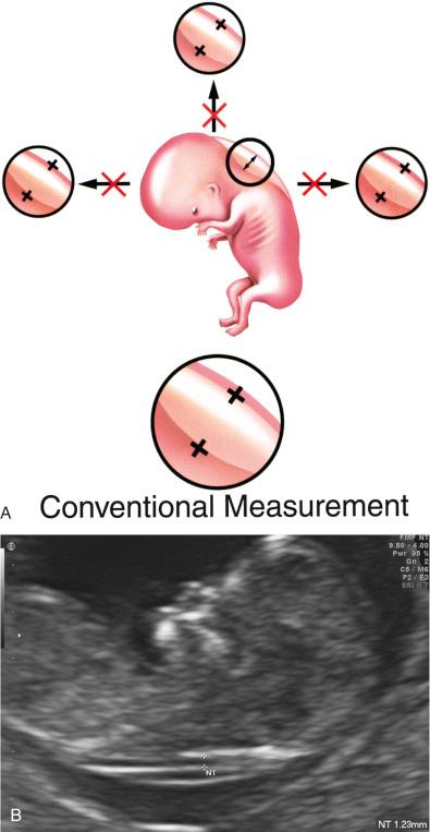 FIG 3-29, Technique for obtaining accurate first trimester nuchal translucency (NT) measurement. A, Demonstration of appropriate caliper placement. B, Demonstration of appropriate magnification, fetal neck position, and visualization of the amnion. Illustration by James A. Cooper, MD, San Diego, CA.