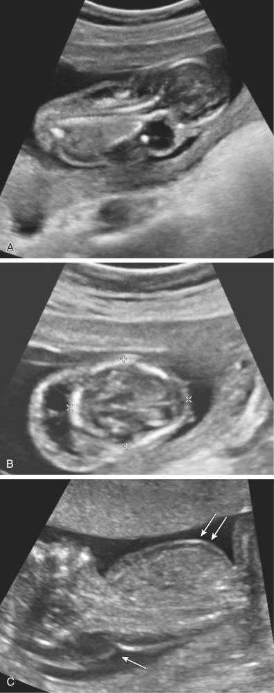 FIG 3-30, A, Coronal view of a septated cystic hygroma in the first trimester of pregnancy in a fetus ultimately diagnosed with trisomy 18. B, Transverse view of the fetal head and neck in the same fetus demonstrating a midline septation. C, Sagittal view of another fetus with a cystic hygroma ( arrow ) with subcutaneous edema ( double arrows ).