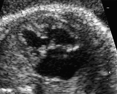 FIG 3-3, Transverse axial view of the fetal chest, showing a complete atrioventricular canal defect of the heart in a Down syndrome fetus. Note the primum atrial septal defect and inlet ventricular septal defect at the crux of the heart, along with a single atrioventricular valve.