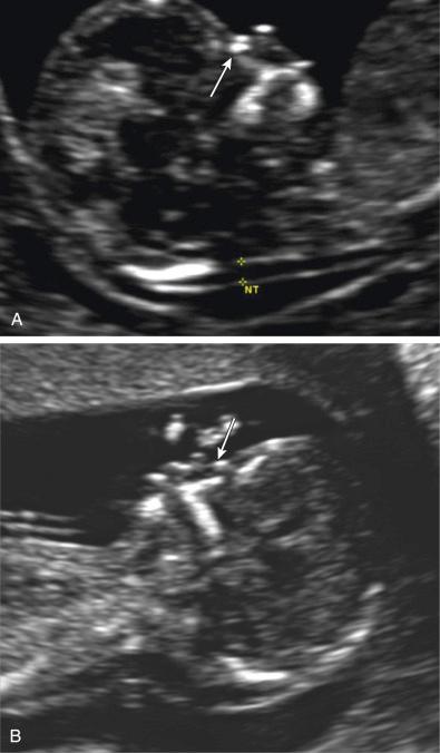 FIG 3-31, A, First trimester ultrasound examination at 13 weeks' gestation demonstrating the presence of a nasal bone ( arrow ) below and parallel to the overlying skin. B, Absent nasal bone ( arrow ) in a fetus with trisomy 21. The nuchal translucency is also enlarged in this fetus.