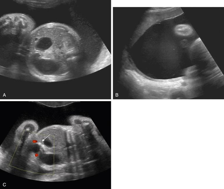 FIG 3-4, Duodenal atresia in a fetus with Down syndrome. A, A transverse axial scan of the abdomen in the third trimester demonstrates the classic “double bubble” sign. ( B ) Polyhydramnios was also present, as was echogenic bowel ( C ) ( arrow ).