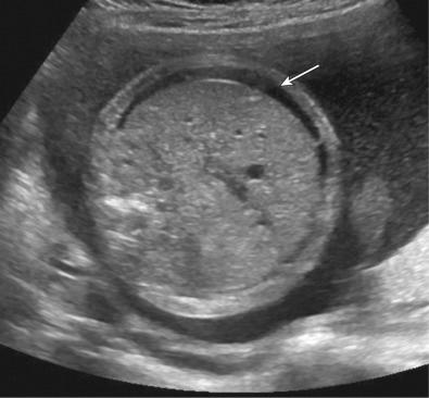 FIG 3-5, Transverse axial view of the fetal abdomen, demonstrating ascites ( arrow ) associated with nonimmune hydrops.