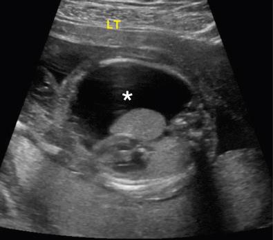 FIG 3-7, Transverse axial view of the fetal chest, demonstrating a large, unilateral pleural effusion ( asterisk ) pushing the heart to the right side of the chest. LT, left thorax.