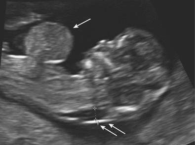 FIG 3-9, Sagittal view of a fetus with an omphalocele ( arrow ) at 13 weeks' gestation. Fetus also has an enlarged nuchal translucency ( double arrows ).