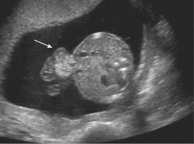 FIG 3-10, Transverse scan of abdomen in a second trimester fetus demonstrating a small omphalocele ( arrow ) containing only small bowel.