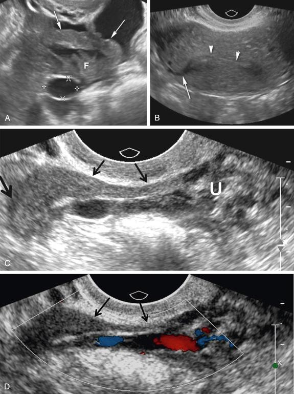 FIG 31-2, Normal fallopian tubes. A, A small amount of anechoic free fluid surrounds the fallopian tube ( arrows ). Note anechoic paratubal cyst ( calipers ) adjacent to the fimbriated end (F). B, A partial coronal view of the uterine fundus demonstrating a trace amount of fluid ( arrow ) in the interstitial portion of the right fallopian tube; endometrium is indicated by arrowheads . C, Normal fallopian tube ( arrows ) coursing from the cornua of the uterus (U) above the anechoic uterine vessels to the right adnexa. Note that the more medial isthmic portion ( thin arrows ) of the tube is the thinnest segment, whereas the fimbriated end ( thick arrow ), which usually sits above or “caps” the ovary, is the thickest segment. D, Color Doppler image of the same patient in C demonstrating the fallopian tube ( arrows ) above the uterine vessels ( blue/red ).