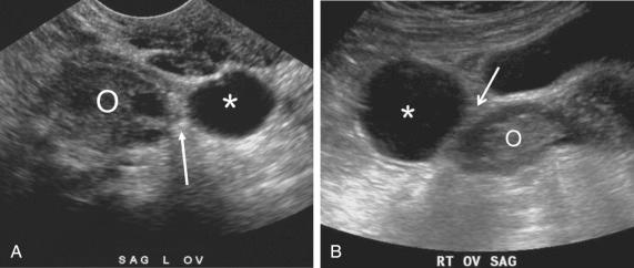 FIG 31-3, Paratubal cysts. A and B, Two different patients with paratubal cysts ( asterisks ). Note echogenic fat plane ( arrows ) clearly separating the paratubal cysts from the adjacent ovary (O).