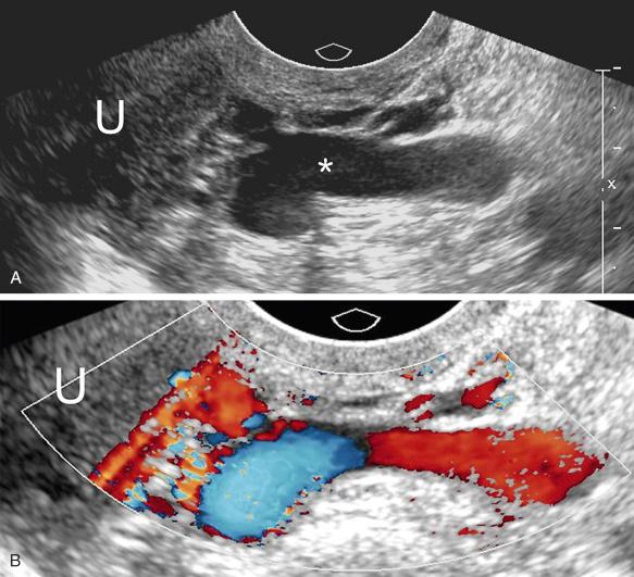 FIG 31-4, Pelvic varix mimicking hydrosalpinx. A, Gray-scale image demonstrating an anechoic serpiginous tubular structure ( asterisk ) adjacent to the left uterine cornua (U) that could easily be mistaken for a hydrosalpinx. However, color Doppler imaging ( B ) demonstrates that the structure fills in with color, consistent with a pelvic varix. Uterine cornua (U).