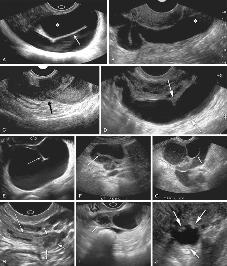 FIG 31-5, The varied ultrasound image appearance of hydrosalpinx. A, Dilated anechoic tubular left adnexal structure in a U shape is consistent with hydrosalpinx. Note that the ampullary end ( asterisk ) anteriorly is wider than the isthmic portion of the tube, which is more posterior on this image. The linear echogenic structure ( arrow ) between the ampullary and isthmic segments represents the two juxtaposed inner walls of the tube as it folds on itself and has been described as the “incomplete septation sign.” Unlike a true septation, the incomplete septation of a folded tube will not extend from wall to wall and the lumen of the tube will remain open around the free edge. This sign helps to differentiate a folded hydrosalpinx from a complex, cystic adnexal mass. B, Serpiginous or S-shaped hydrosalpinx. The more lateral ampullary end ( asterisk ) is wider than the isthmus. C, Often there is an abrupt transition in diameter ( arrow ) between the wider ampullary portion of the tube and the isthmus ( calipers ) as in this patient with a dilated left fallopian tube containing internal echoes consistent with pyosalpinx. D, Waist sign: Note indentations ( arrows ) on opposing sides of the dilated fallopian tube believed to be due to thickening of the endosalpingeal folds. E, Incomplete septation sign: Note the thin linear echogenic structure ( arrow ) appearing to protrude into the dilated fallopian tube. This represents the apposition of two segments of the inner wall of the fallopian tube as it folds on itself and, therefore, does not extend across the entire diameter of the dilated fallopian tube. This appearance serves to differentiate a folded fallopian tube from a complex cystic adnexal mass with a true septation that would extend from wall to wall. F, Incomplete septation sign ( arrow ) in a second patient with a serpiginous dilated fallopian tube containing low level internal echoes consistent with pyosalpinx. The more dilated ampullary segment is located anteriorly. G, Incomplete septation sign ( arrow ) in another patient with pyosalpinx. Note the left ovarian cyst ( calipers ) with fine reticular pattern of internal echoes, likely representing hemorrhage or possibly infection. H, Cogwheel sign: Note the slightly dilated, thick-walled tortuous fallopian tube visualized on this image in both long axis ( long arrow ) and in cross section ( short arrows ). Note several mural-based small nodules on cross section representing thickened endosalpingeal folds. This appearance has been termed the cogwheel sign. I, Cogwheel sign: Note numerous echogenic, thickened, endosalpingeal folds regularly spaced around the periphery of the dilated fallopian tube in this patient with chronic salpingitis. In cross section ( arrow ), these thickened folds may appear nodular, mimicking cystic ovarian malignancy except that these folds are so regularly spaced and symmetric. J, Beads on a string sign: Note the slightly dilated thin-walled fallopian tube in cross section with multiple mural-based echogenic nodules ( arrows ) due to thickening of the endosalpingeal folds, resulting in the appearance of “beads on a string.”