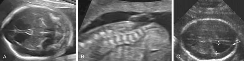 FIG 9-7, Open spina bifida (myelomeningocele). A, Typical associated intracranial findings including scalloping of the bilateral frontal bones and small posterior fossa with obliteration of the cisterna magna. B, Large vertebral defect with overlying septated cyst. C, Axial sonographic image of a fetus with Chiari II malformation and normal-size ventricle showing pointed configuration ( arrow ) of the occipital horn.