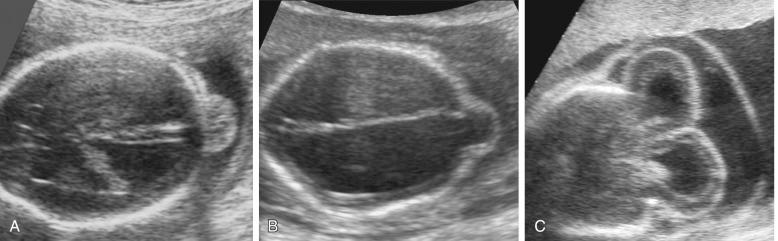 FIG 9-9, Cephalocele. A, Small occipital cephalocele; B, small occipital cephalocele with severe ventriculomegaly; C, large occipital cephalocele with large cranial defect and marked extracranial displacement of the brain.