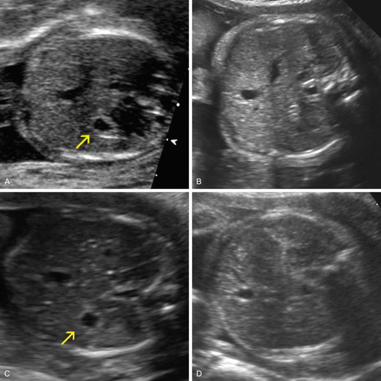 FIG 14-2, Esophageal atresia. A, This fetus had multiple anomalies seen at 19 weeks. The stomach bubble ( arrow ) and the amniotic fluid volume were normal. B, The same fetus as in A at 30 weeks. At this time the stomach bubble was absent and there was mild polyhydramnios. The child had esophageal atresia with tracheoesophageal fistula and CHARGE syndrome (see Table 14-3 ). C, The patient was 41 years old and declined aneuploidy screening. At 19 weeks, the fetal stomach bubble ( arrow ) and the amniotic fluid volume were normal. D, The same fetus as in C at 28 weeks. At this time the stomach bubble was absent and there was mild polyhydramnios. The child had esophageal atresia (without tracheoesophageal fistula) and Down syndrome.