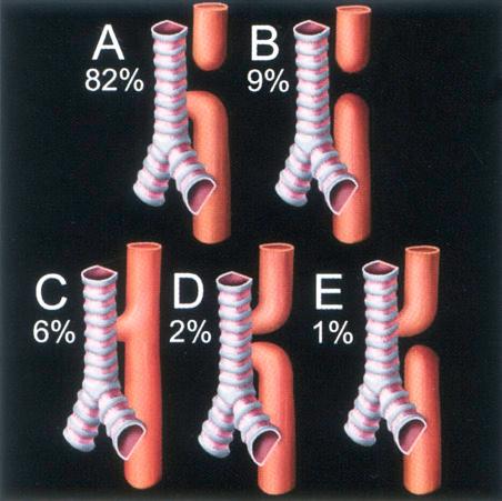 FIG 14-3, Graphic illustration of the five main types of esophageal atresia with and without tracheosophageal fistula.