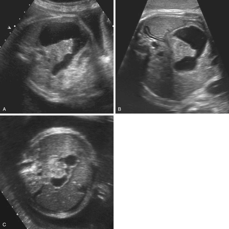 FIG 14-4, Duodenal obstruction. In these three fetuses the diagnosis of duodenal obstruction was made in the third trimester. All three demonstrate similar, characteristic ultrasound findings with fluid shown in the stomach and proximal duodenum. A, This fetus was first seen at 34 weeks. On postnatal evaluation, he was found to have an annular pancreas and normal chromosomes. He is doing well except for gastroesophageal reflux. B, Duodenal atresia in a fetus with Down syndrome. C, This pregnancy was followed for mild fetal ascites (see Fig. 14-18 ). Evidence of duodenal obstruction and mild polyhydramnios was noted by ultrasound examination at 31 weeks. The child has Down syndrome and underwent an open duodeno-duodenostomy on day 9 of life.