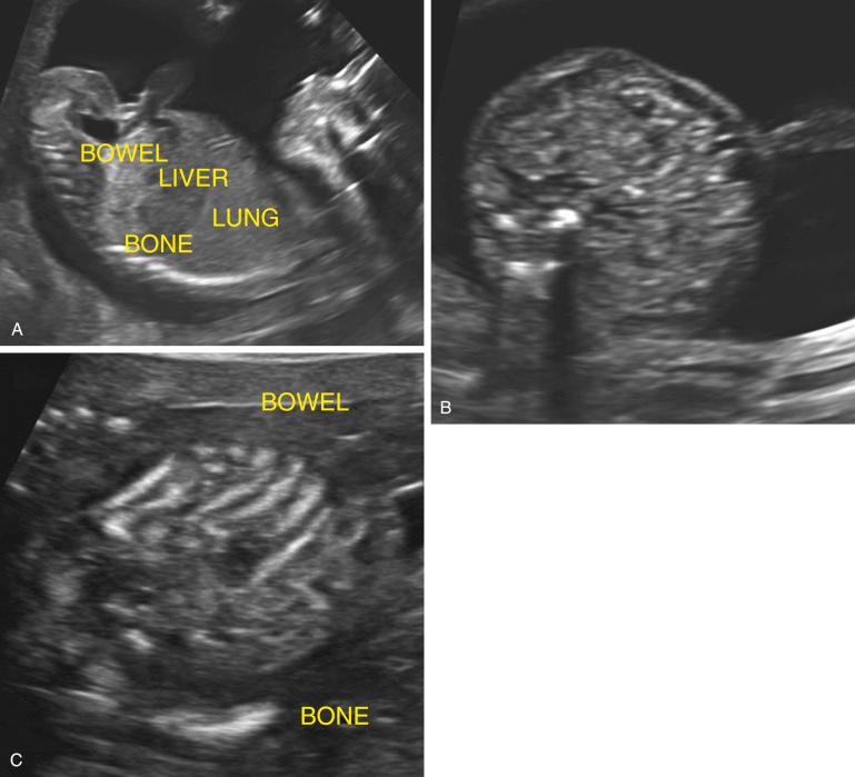 FIG 14-5, Normal intestine in the second trimester. A, Midline sagittal view through the normal fetal abdomen. In order of increasing echogenicity: liver, lung, bowel, bone. B, Characteristic appearance of fetal intestine in the second trimester, shown on this transaxial view through the midabdomen. C, Using a 9-MHz transducer, the settings were deliberately manipulated to give the intestine an abnormal appearance such that, as a result of artifact, the echogenicity of bowel is as bright as iliac bone.