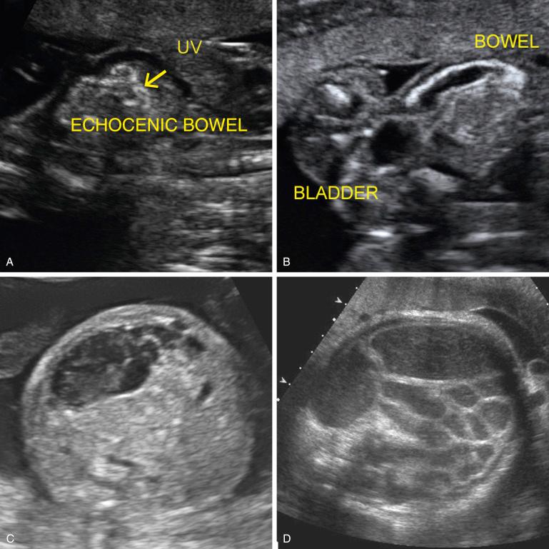 FIG 14-6, Evolution of jejunoileal obstruction. A, Typical sonographic appearance of echogenic fetal bowel ( arrow ) at 19 weeks. UV, umbilical vein. B, Of note on this follow-up examination, a slightly dilated loop of small bowel with an echogenic rim is shown. C, At 23 weeks, a heterogeneous intra-abdominal cystic structure with echogenic margins was noted, indicating a meconium pseudocyst. D, Progressive dilatation of fluid-filled small bowel segments was observed on serial obstetric sonograms. This is the appearance at 37 weeks. Immediately after birth, the child underwent resection of 27 cm of small bowel, with anastomosis of 104 cm of proximal to 52 cm of distal small bowel. She is now doing well without nutritional deficiencies.