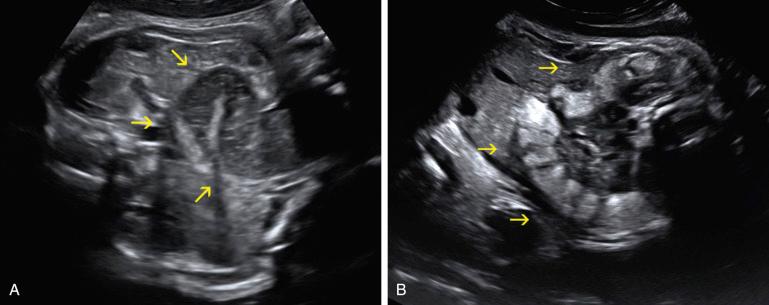 FIG 14-7, Normal fetal colon. A, Normal fetal colon in the third trimester appears as hypoechoic loops of varying size at the periphery of the abdomen and in the pelvis ( arrows ). B, Echogenic colon ( arrows ) is a benign finding when seen after 36 weeks.