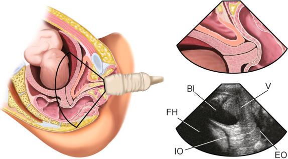 FIG 18-1, Diagrams and sonogram of the female pelvis demonstrating placement of the ultrasound transducer for translabial imaging of the gravid cervix. Bl, bladder; EO, external os; FH, fetal head; IO, internal os; V, vagina.